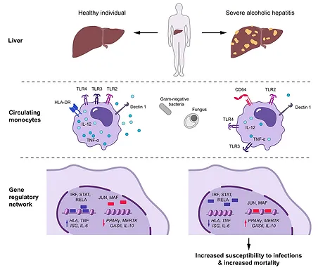 Epigenetic basis for monocyte dysfunction in acute-on-chronic liver failure and alcoholic hepatitis